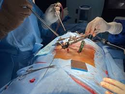 Endoscopic Spine Surgery in Kerala