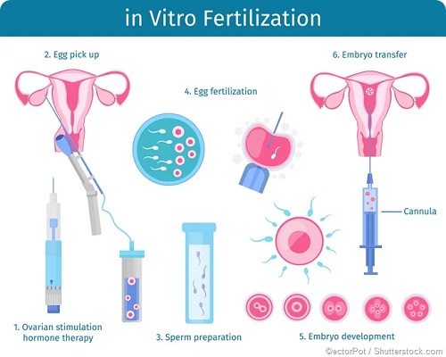 in Vitro Fertilization in India
