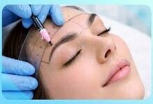 Eyebrow Transplant Chicago