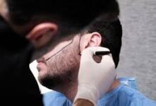Beard Transplant Chicago