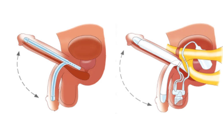 Penile Implant in India