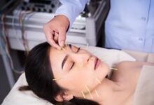 Thread Lift Treatment in Kolkata